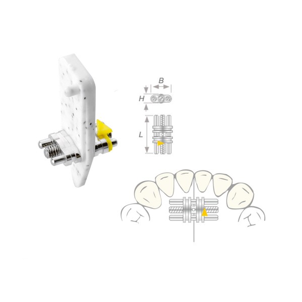 Dehnschraube Vector 090 mini 10St